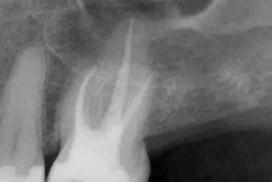 Wurzelbehandlung Endodontie