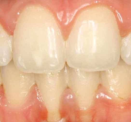 Parodontitis und Parodontose